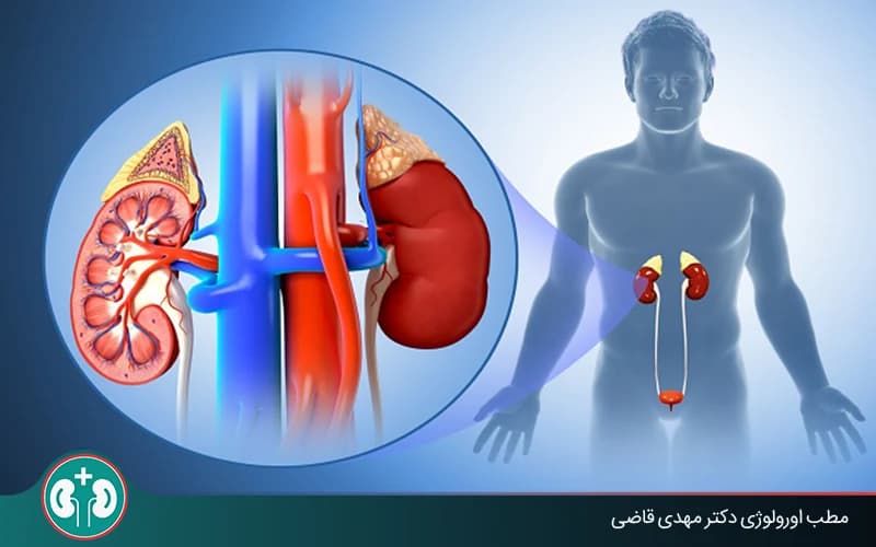 پیلونفریت چیست؟ علائم عفونت کلیه، تشخیص و درمان
