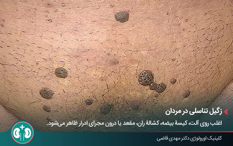 تصویر بالینی از نشانه‌های زگیل تناسلی تیره‌رنگ در مردان