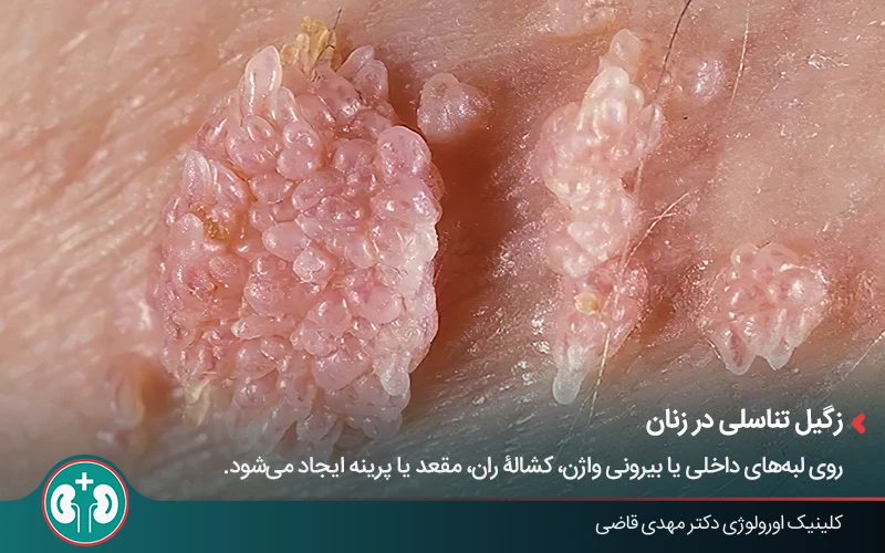 ظاهر زگیل تناسلی در مراحل پیشرفته و خوشه‌ای