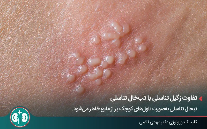 نمای نزدیک از تاول‌های تبخال تناسلی روی پوست ناحیه تناسلی