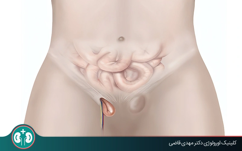 آیا فتق بیضه باعث نازایی میشود؟ بررسی علمی و راهکارهای پیشگیری