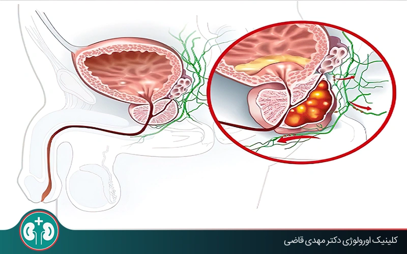 آیا التهاب پروستات باعث سرطان میشود؟ بررسی علمی و توصیههای پیشگیرانه