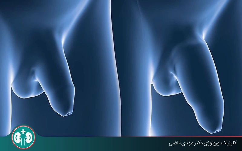 عمل پنوپلاستی برای افزایش طول و قطر آلت؛ بررسی مزایا، عوارض و مراقبتها