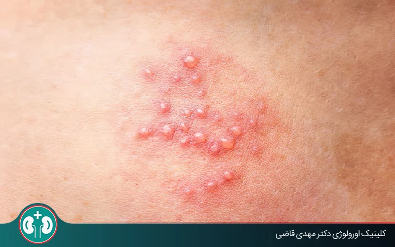 آیا تبخال تناسلی از طریق لباس منتقل میشود؟