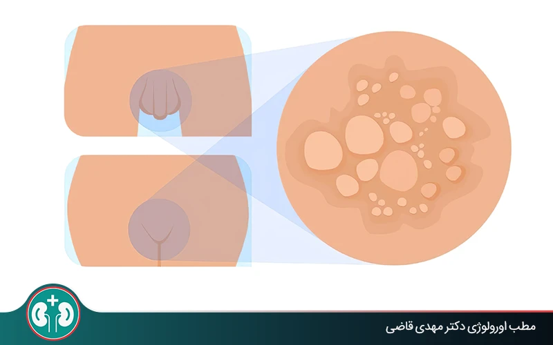 شناخت شکلها و تفاوتهای انواع زگیل تناسلی؛ عکس و نکات تشخیص