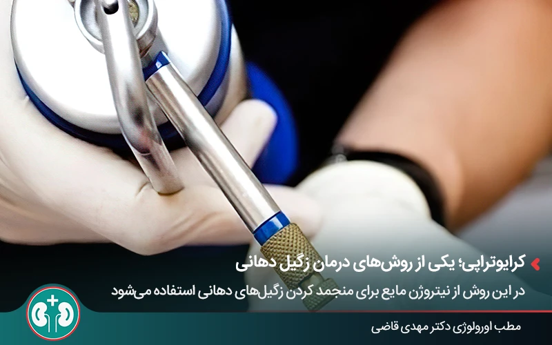کرایوتراپی، یکی از روش‌های درمان زگیل تناسلی دهان
