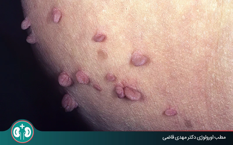 زگیل تناسلی بعد از چند وقت نمایان میشود؟ دورۀ نهفتگی و علائم بروز آن
