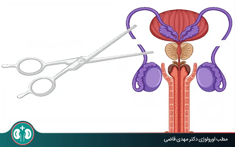 آیا با بستن لوله مردان باز احتمال بارداری وجود دارد؟