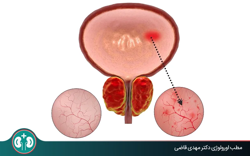 سیستیت هموراژیک چیست و چطور درمان می‌شود؟