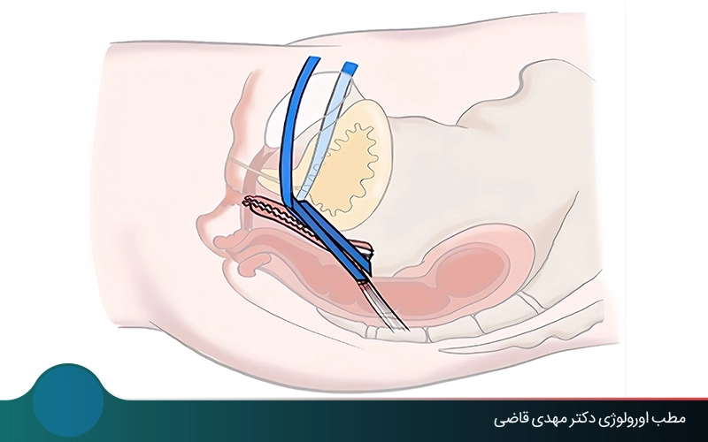 عمل افتادگی مثانه | لاپاراسکوپی، واژینال، عمل باز