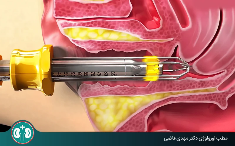 درمان افتادگی مثانه با لیزر برای چه کسانی مناسب است؟