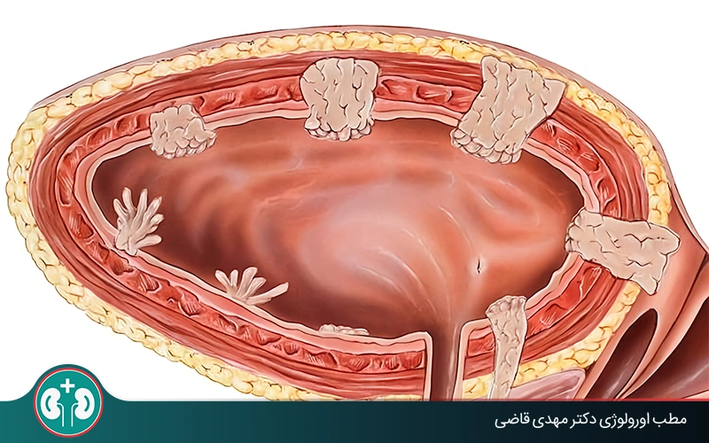 پولیپ مثانه چیست و چگونه درمان می‌شود؟