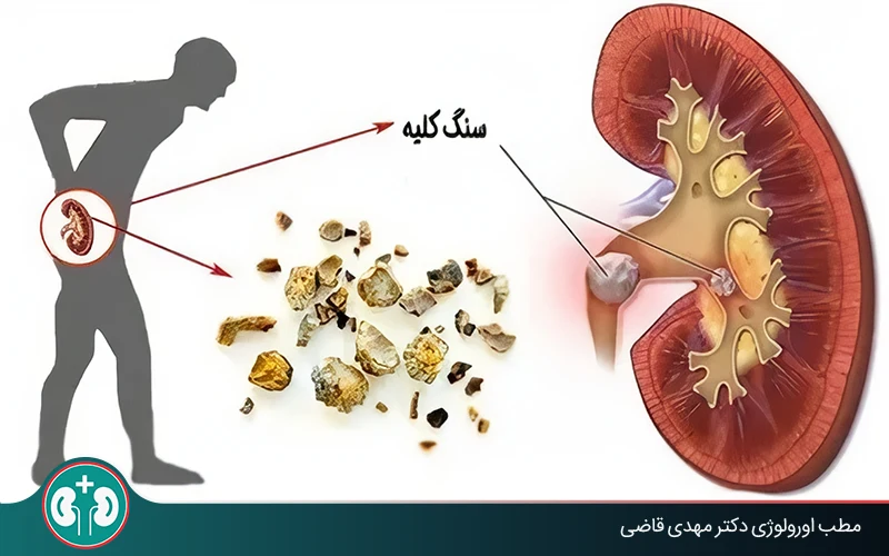 اگر سنگ کلیه در مجاری ادراری باشد چه می‌شود؟