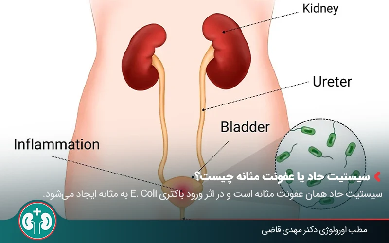 نمودار آناتومی دستگاه ادراری زنانه که محل عفونت را در عفونت مثانه (سیستیت) نشان می‌دهد