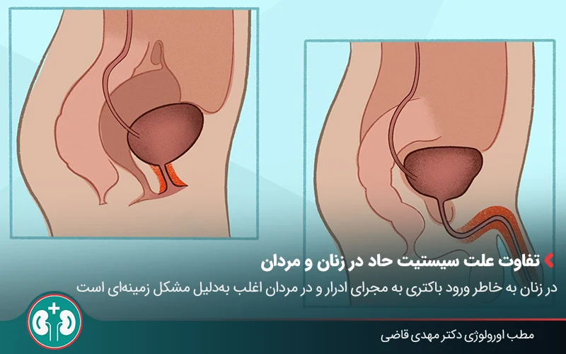تصویری که با مقایسۀ طول مجرای ادرار زنان و مردان، نشان می‌دهد چرا در زنان ورود باکتری‌ها به مثانه آسان‌ است.