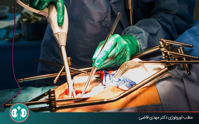 برداشتن مثانه در سرطان مثانه؛ روشها، اثربخشی و عوارض
