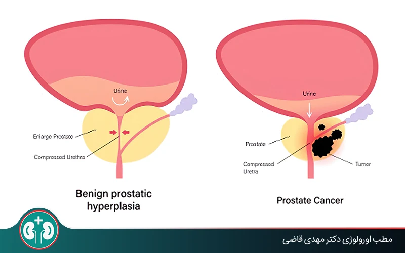 آیا بزرگی پروستات خوش‌خیم به سرطان پروستات تبدیل می‌شود؟