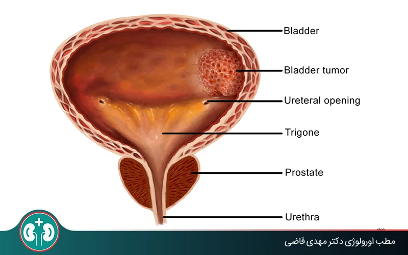 سرطان مثانه خوش‌خیم چیست؟ تفاوت با سرطان مثانه
