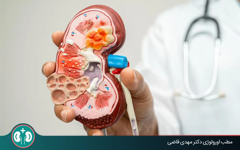 سرطان کلیه چیست؟ آیا سرطان کلیه کشنده است؟