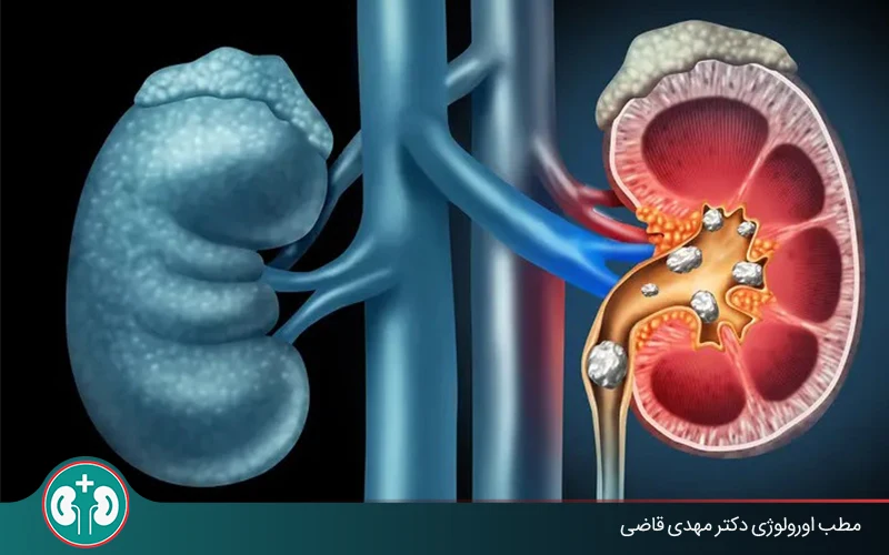 سنگ کلیه در حالب چگونه دفع می‌شود؟