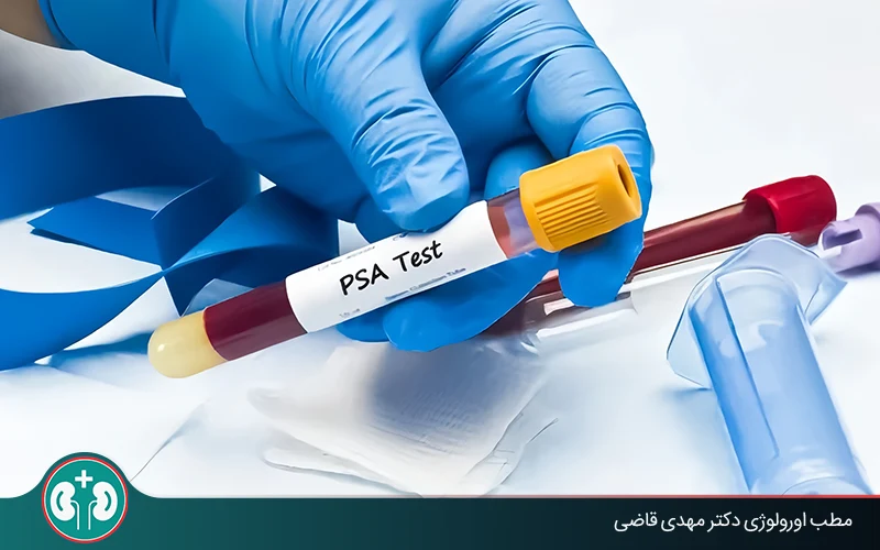 تفسیر عدد PSA بعد از عمل پروستات؛ آیا افزایش آن به معنای سرطان است؟