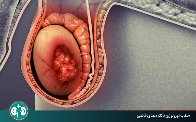 آیا هر توده‌ای در بیضه نشانه سرطان است؟ | مطب دکتر قاضی
