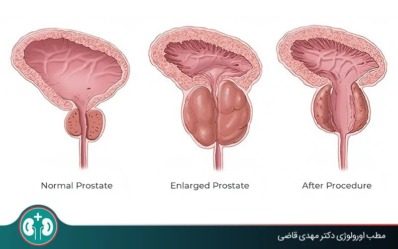 در چه صورتی پروستات باید عمل شود؟ | مطب دکتر قاضی
