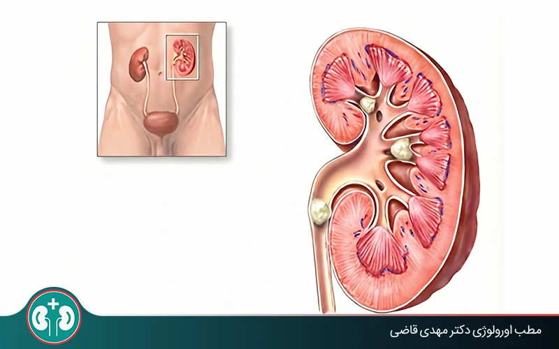 آیا سنگ کلیه می‌تواند باعث از کار افتادن کلیه شود؟