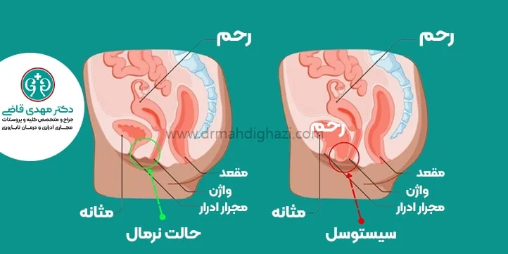بیرون زدگی مثانه دکتر قاضی