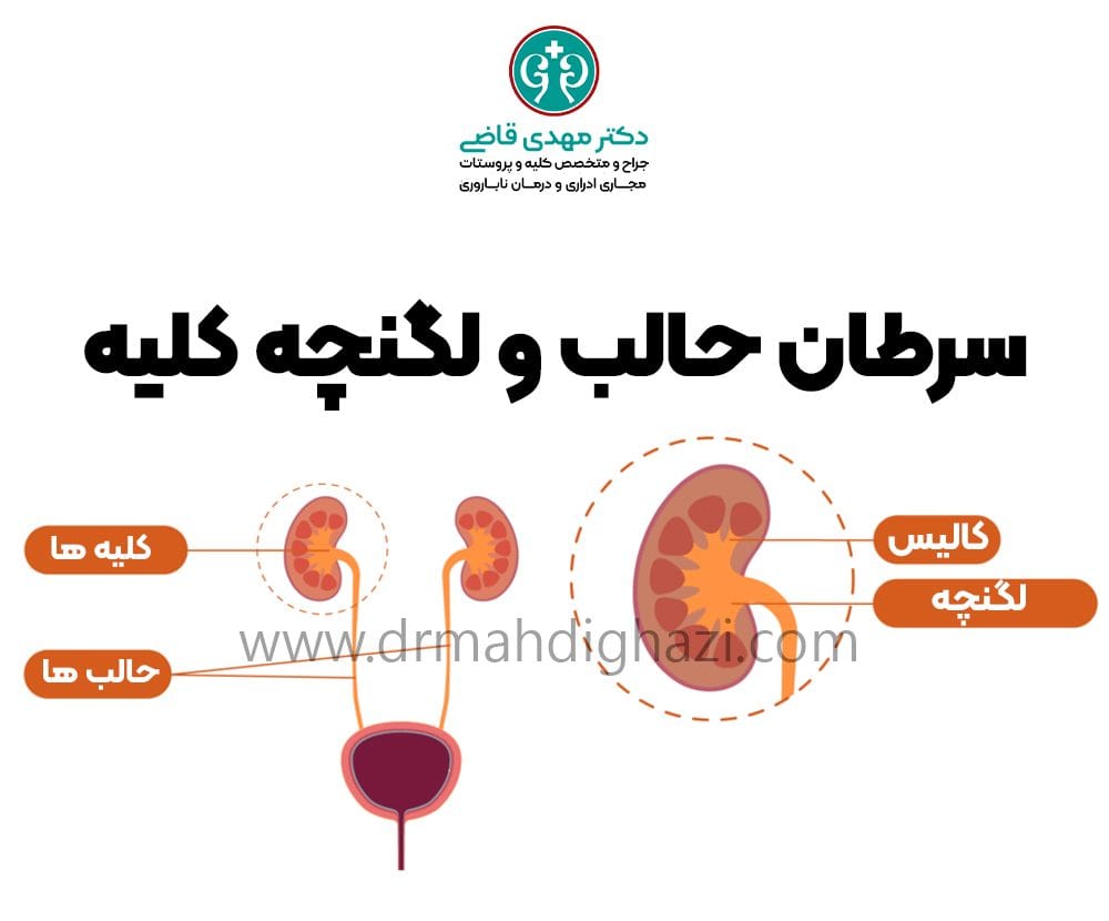 دکتر قاضی-سرطان حالب و لگنچه کلیه: علائم، تشخیص و درمان