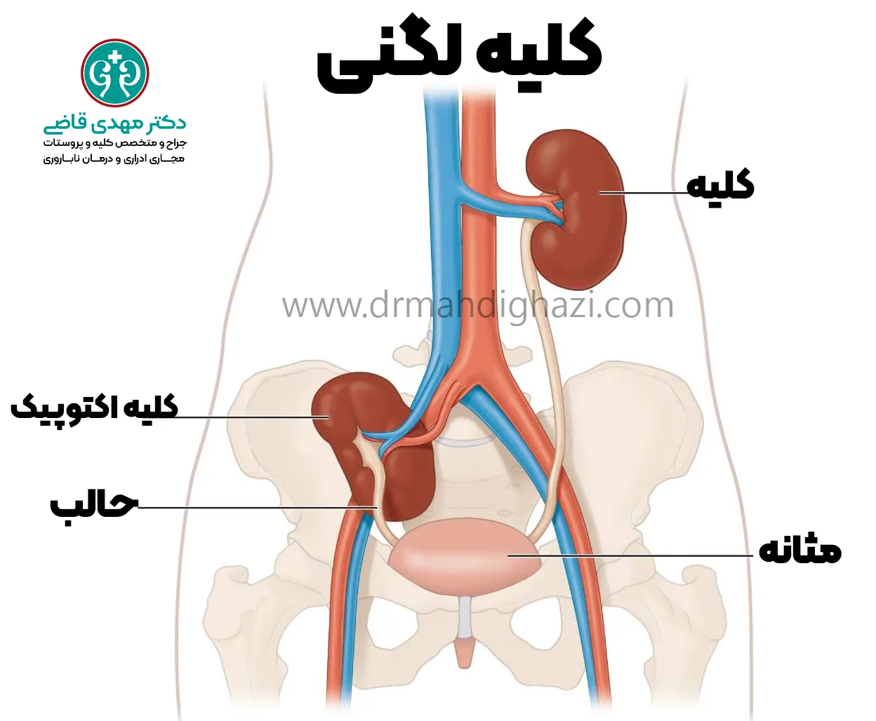 دکتر قاضی- کلیه لگنی