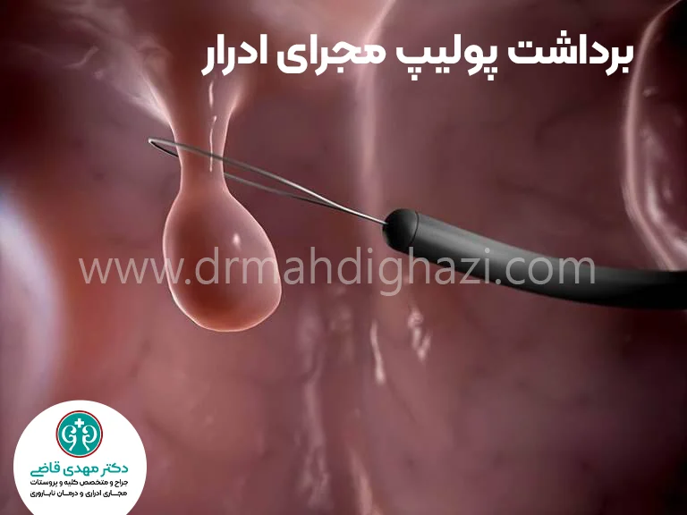دکتر قاضی-• پیشگیری از عوارض توده‌های خوش خیم مجرای ادرار در دختران-• مراقبت‌های پس از جراحی پولیپ مجرای ادرار