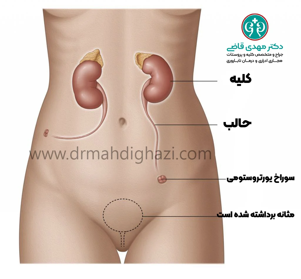 دکتر قاضی- درمان دایورژن ادرار