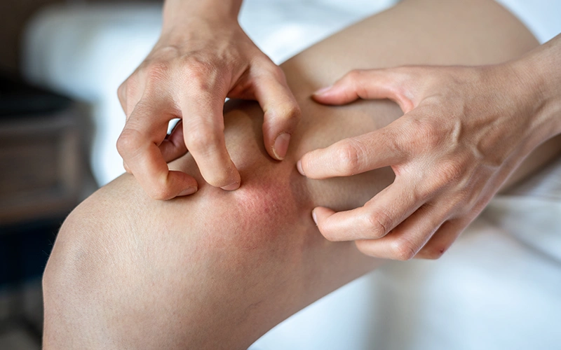سوزش، تحریک و التهاب پوست بر اثر استفاده از واجبی