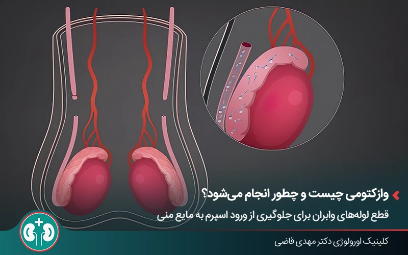 نمای شماتیک دستگاه تناسلی مردان و نحوه قطع لوله‌ها در جراحی وازکتومی
